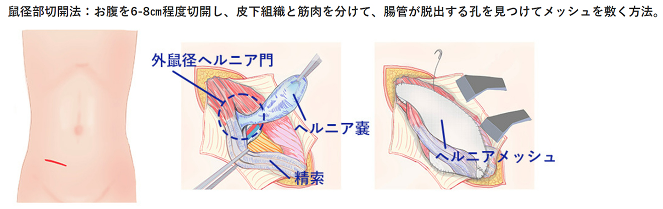 鼠径ヘルニアの治療方法：鼠径部切開と腹腔鏡手術