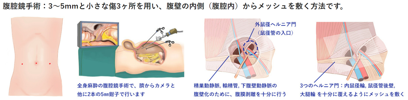 鼠径ヘルニアの治療方法：鼠径部切開と腹腔鏡手術