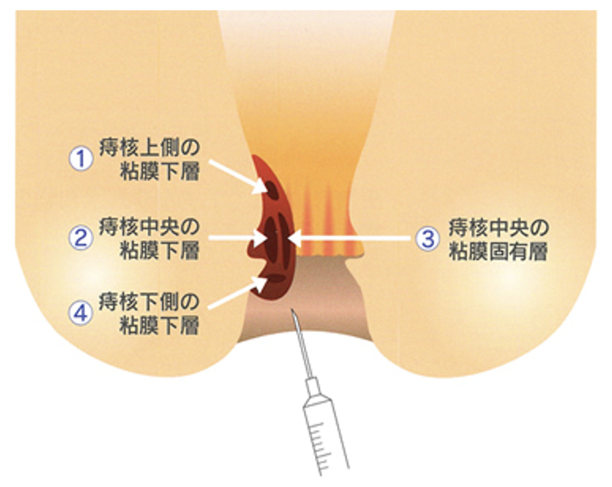 どのようにジオン注を投与するの？